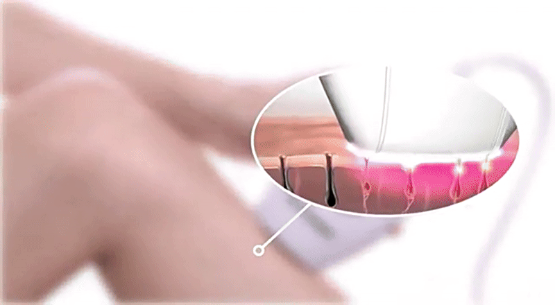 ✨ BREECOZYN LumiFace Pro Épilateur de Peau à lumière pulsée ✨